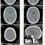 Action on Stroke Month