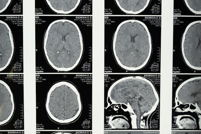 Action on Stroke Month